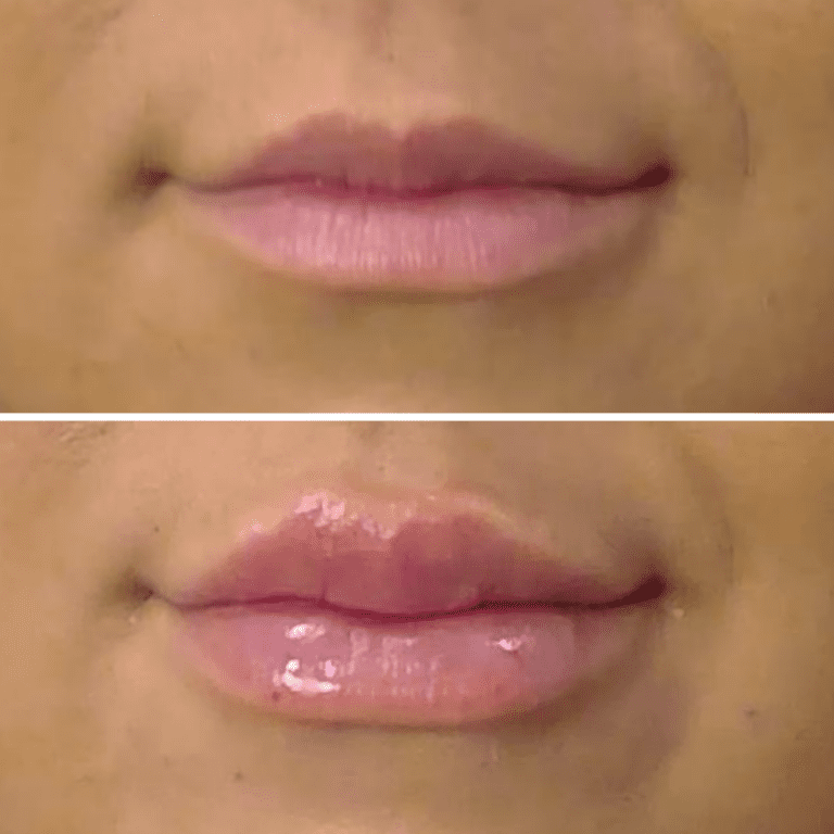 russian lip before and after lip filler