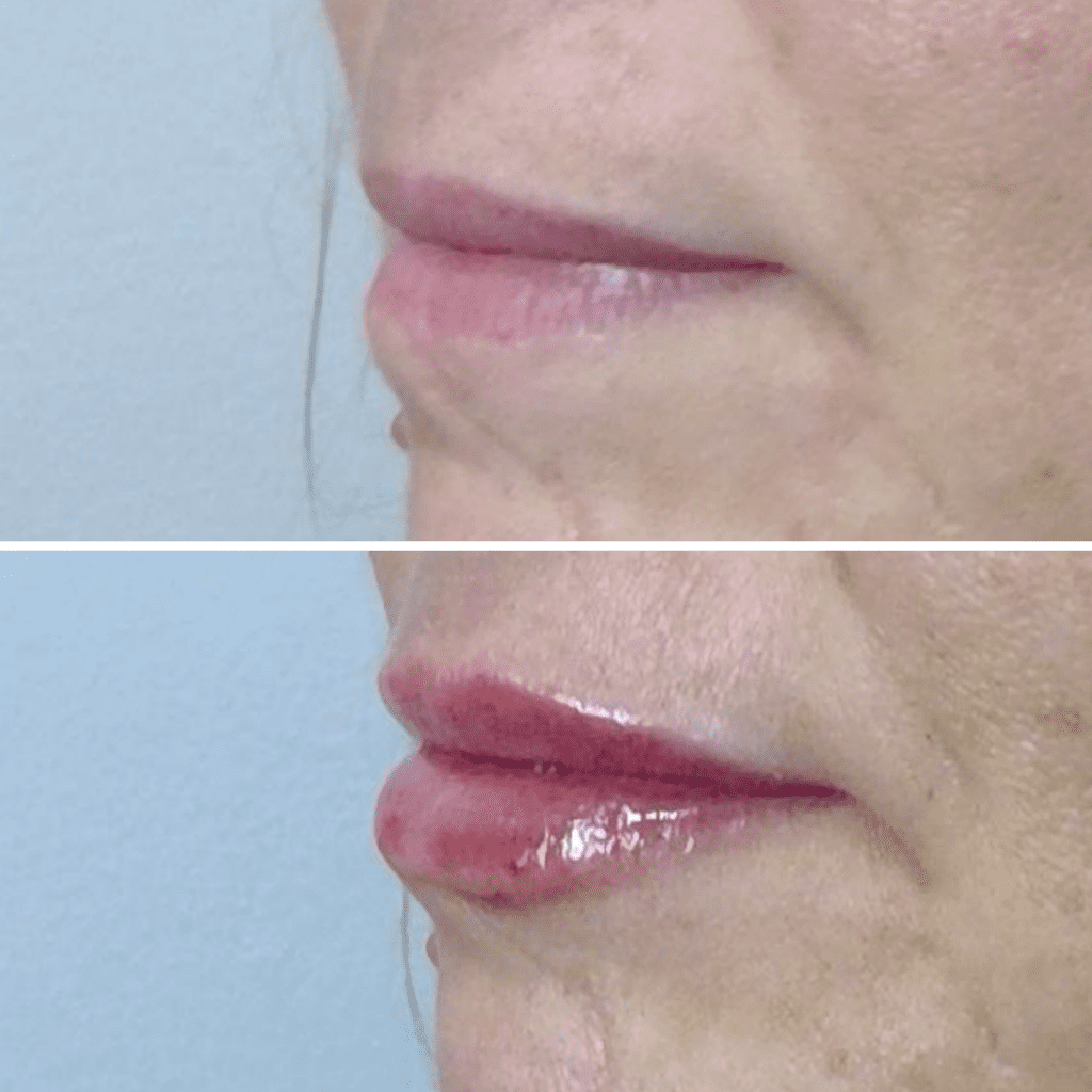 before and after of juvederm lip filler