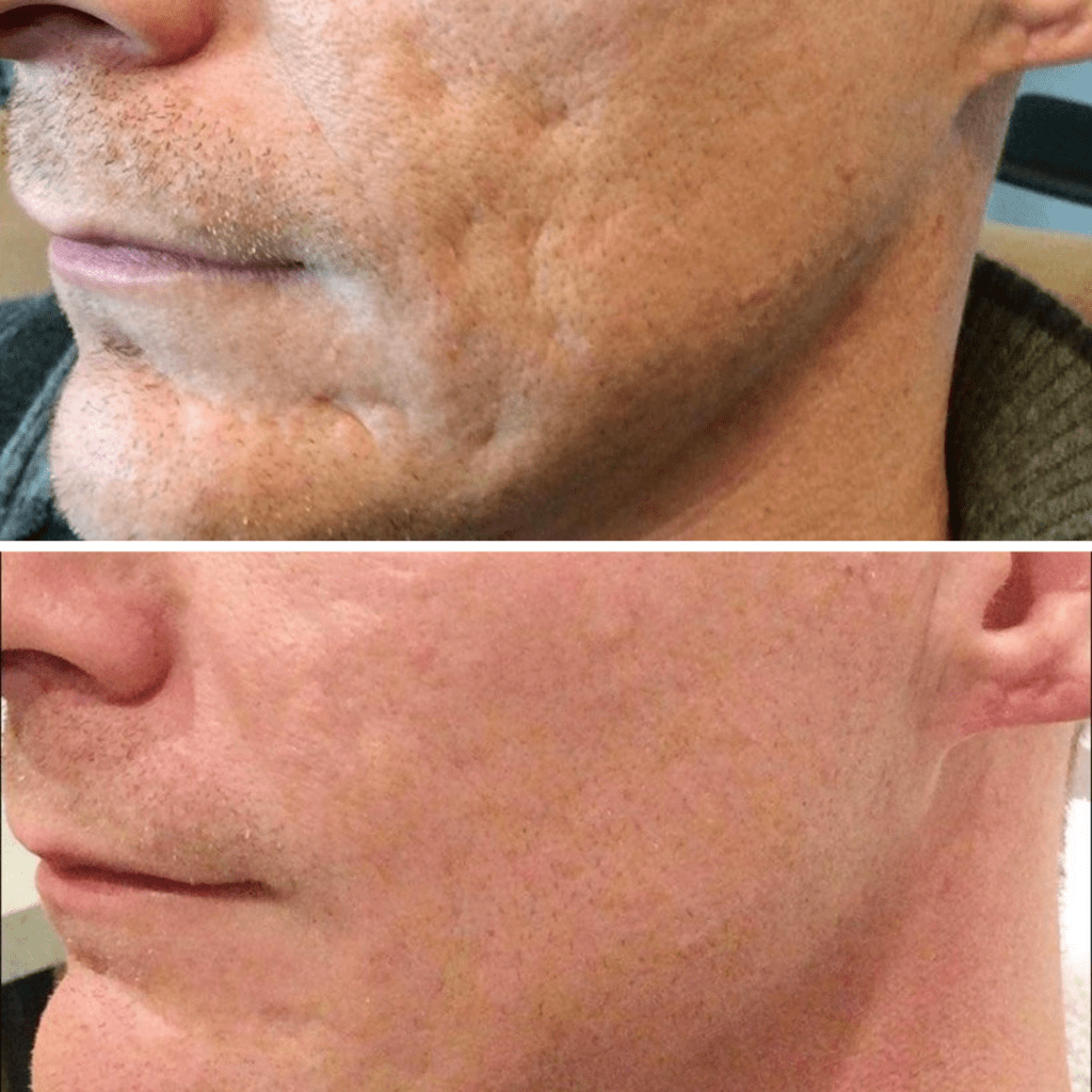 before and after of acne scarring
