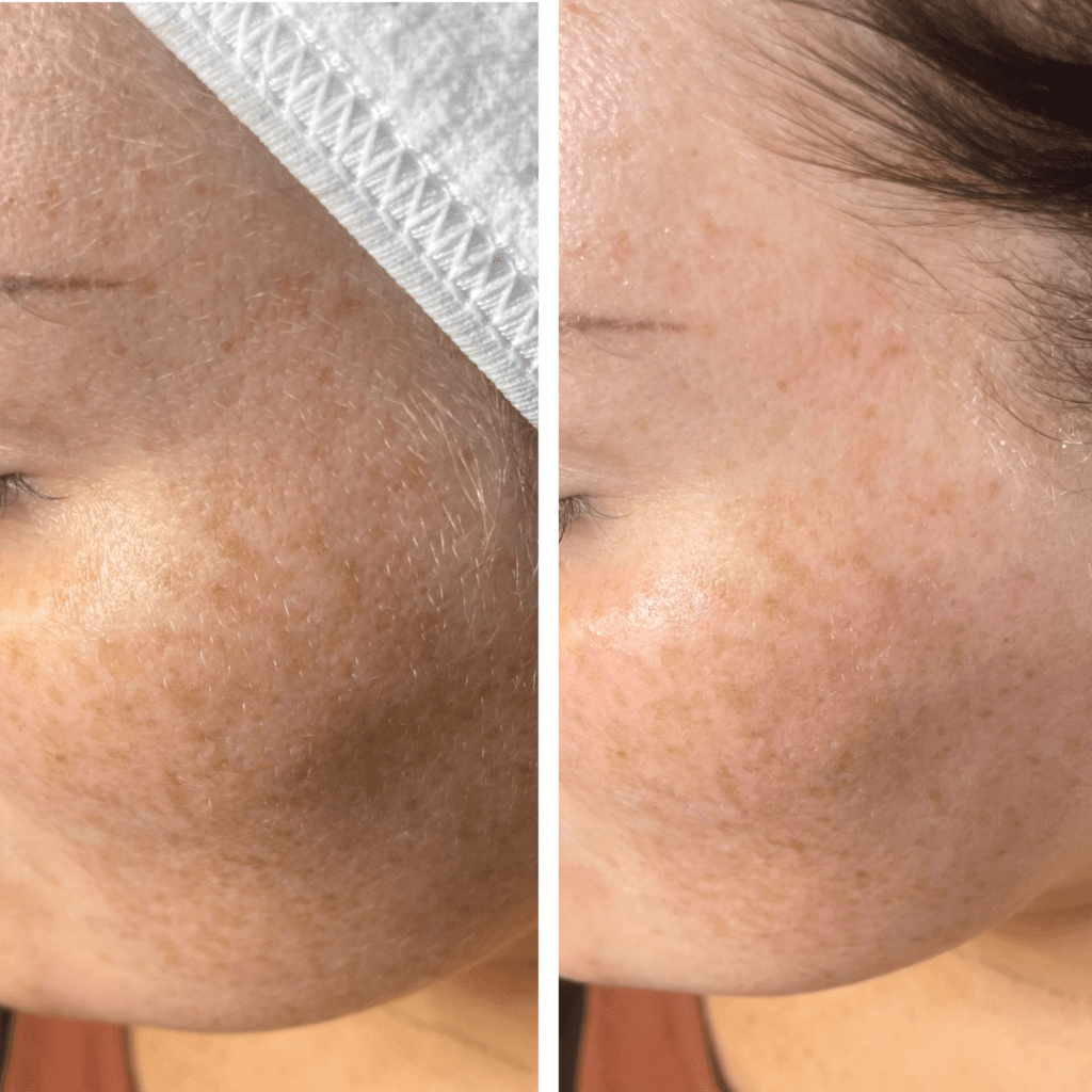 women with before and after results of dermaplaning