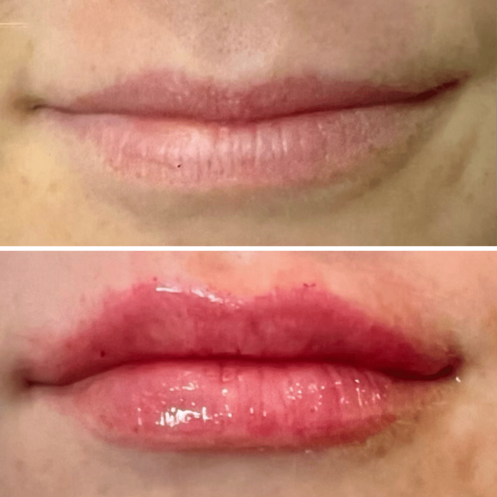 before and after of lip filler