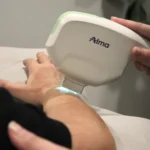 person receiving a laser treatment on the arm and hands to remove dark spots and sun spots. this is an intense pulsed light treatment