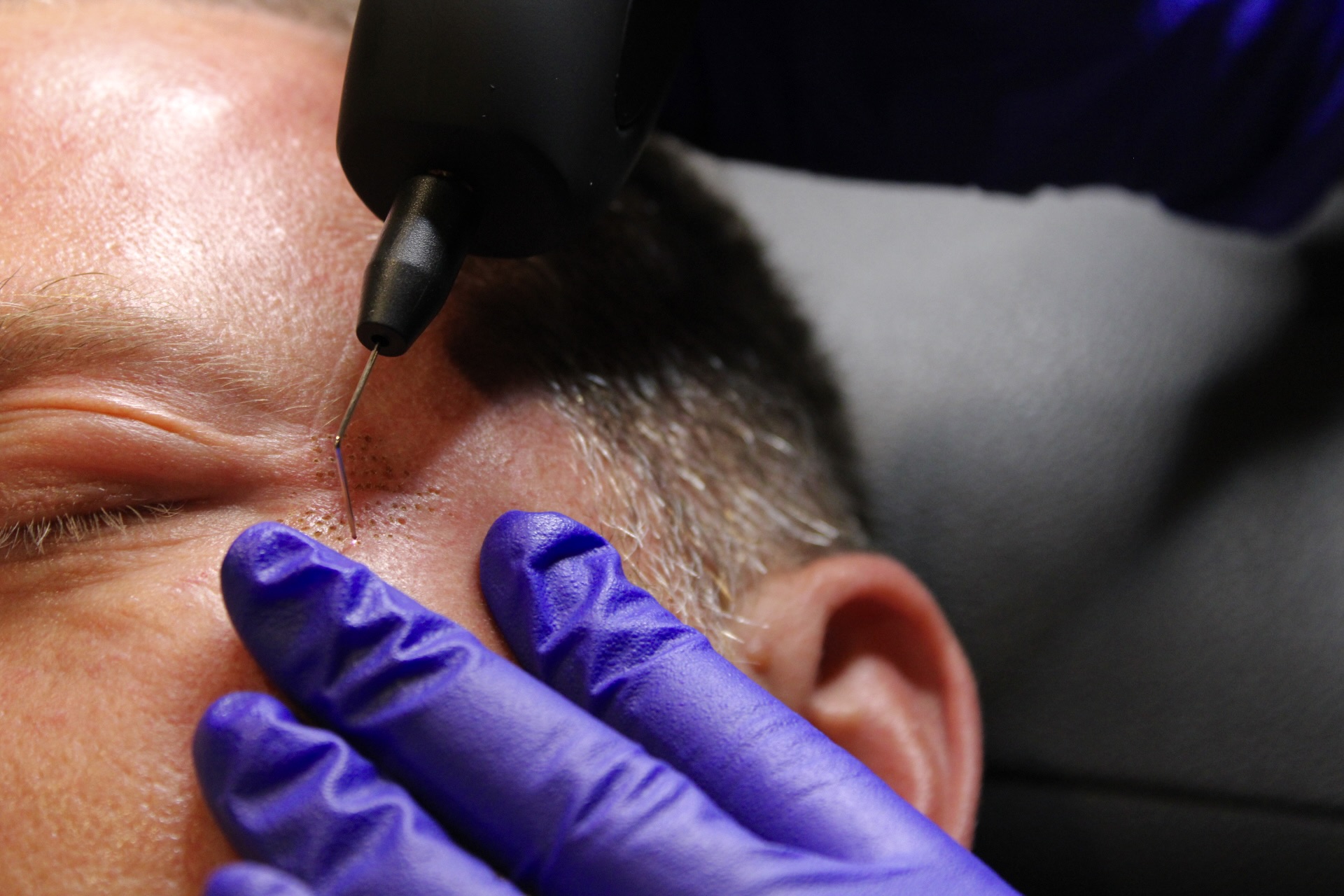 A man receiving a Plasma IQ treatment: non-surgical plasma laser therapy with purple gloves, showcasing effective skin rejuvenation and excellent results.