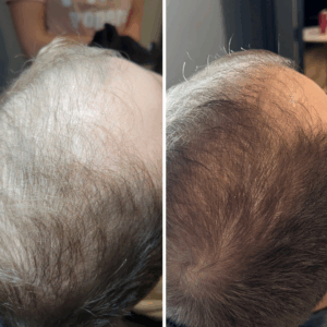 PRP Hair Before and After