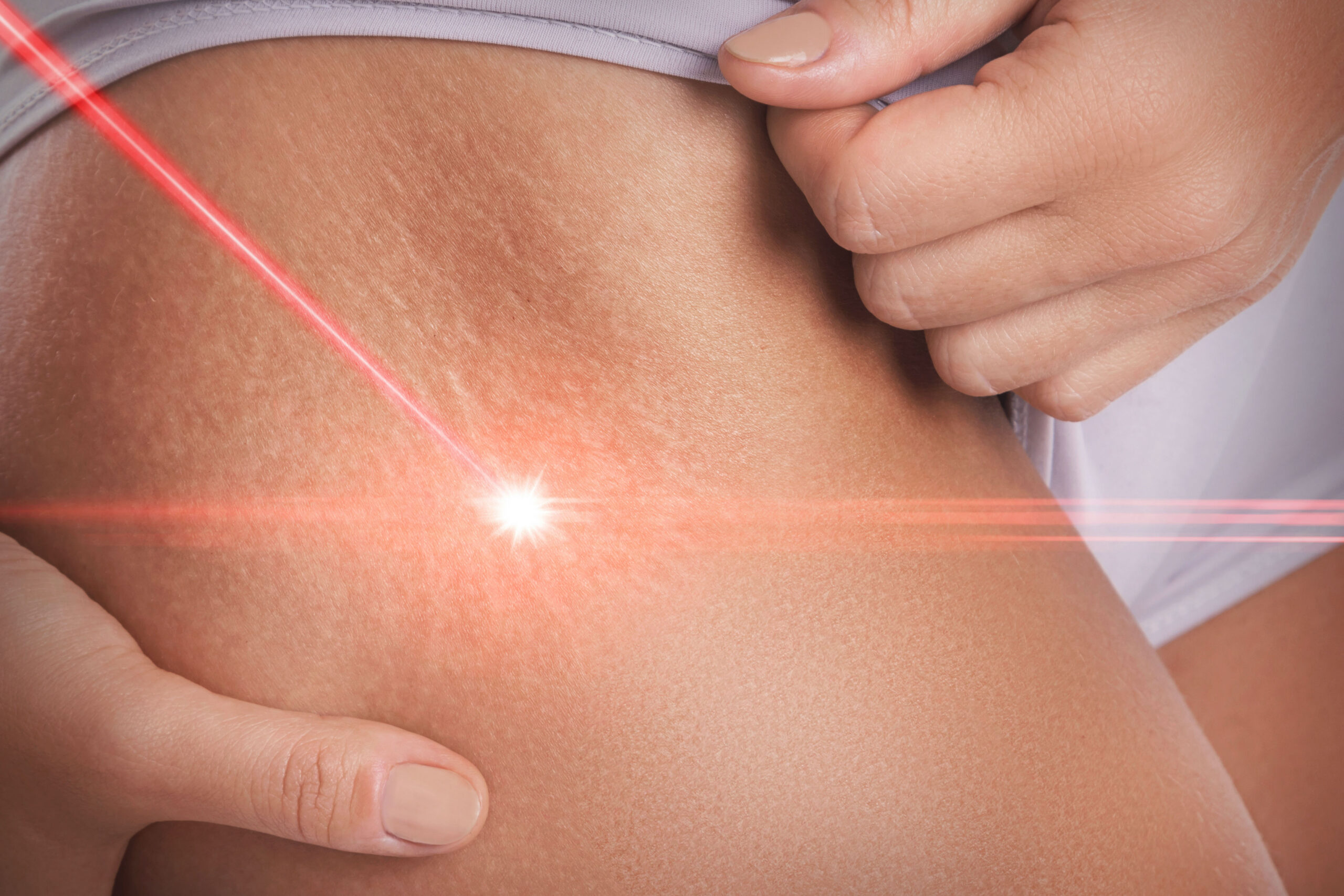 laser scar removal
