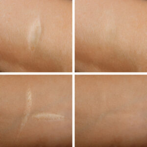 laser scar removals